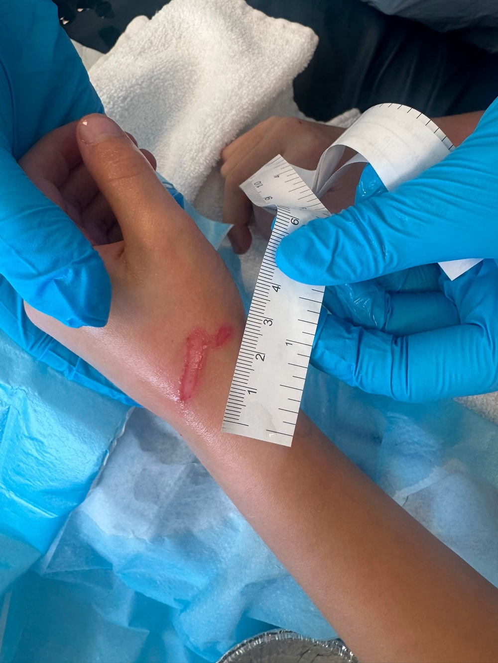 Eight-year-old Joseph from Clackmannanshire, who needed weeks of treatment and a skin graft after a heated squishy toy burst across his chest and hand (NHS Greater Glasgow and Clyde/PA Wire)