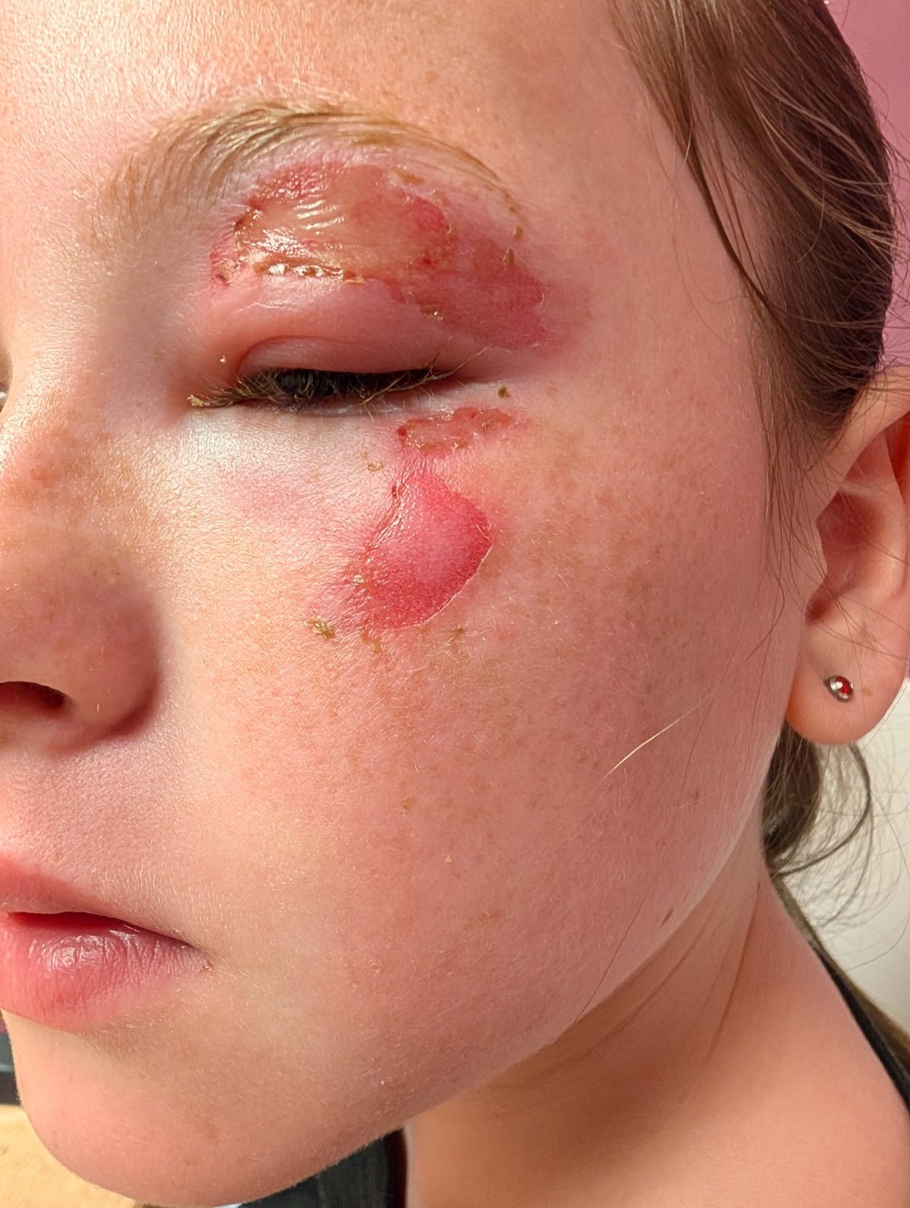 Scarlet Rowe suffered a burn near her eye (Gina Rowe/PA)