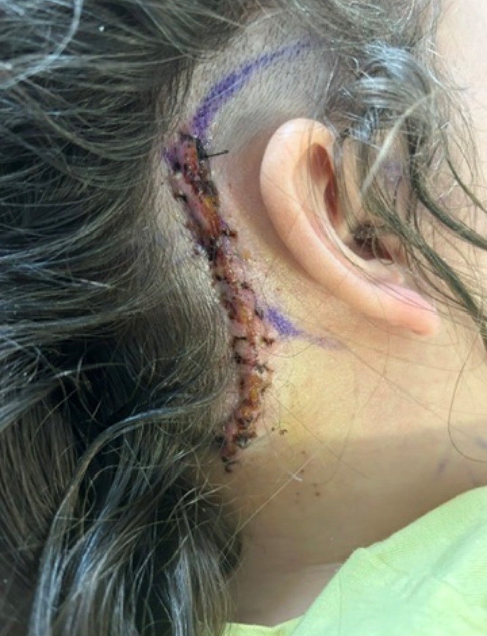 The tumour could not be removed because of its location around critical blood vessels (Lauren Lewington)