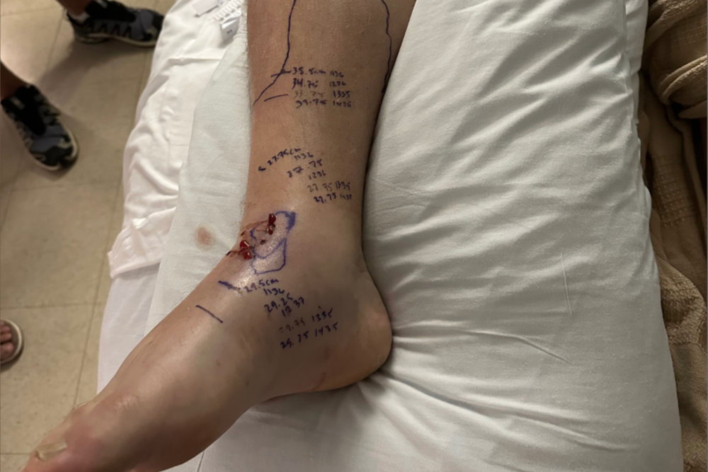 Chris was bitten twice with one bite going through a vein. His wife said that the venom went straight into his bloodstream (GoFundMe)