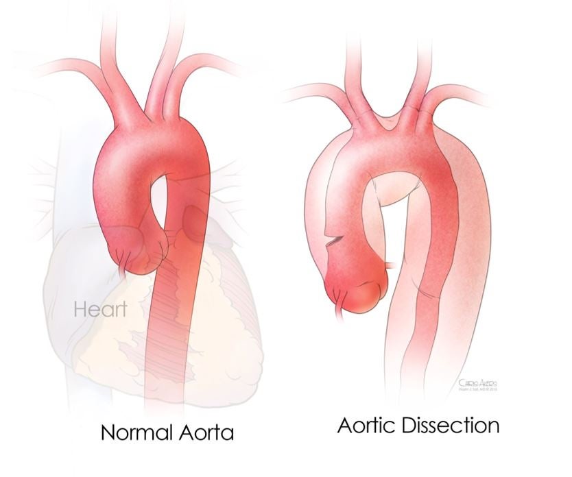 Graham died suddenly from an aortic dissection, according to initial medical reports. Here a chart shows the condition. (McGovern Medical School Department of Internal Medicine)