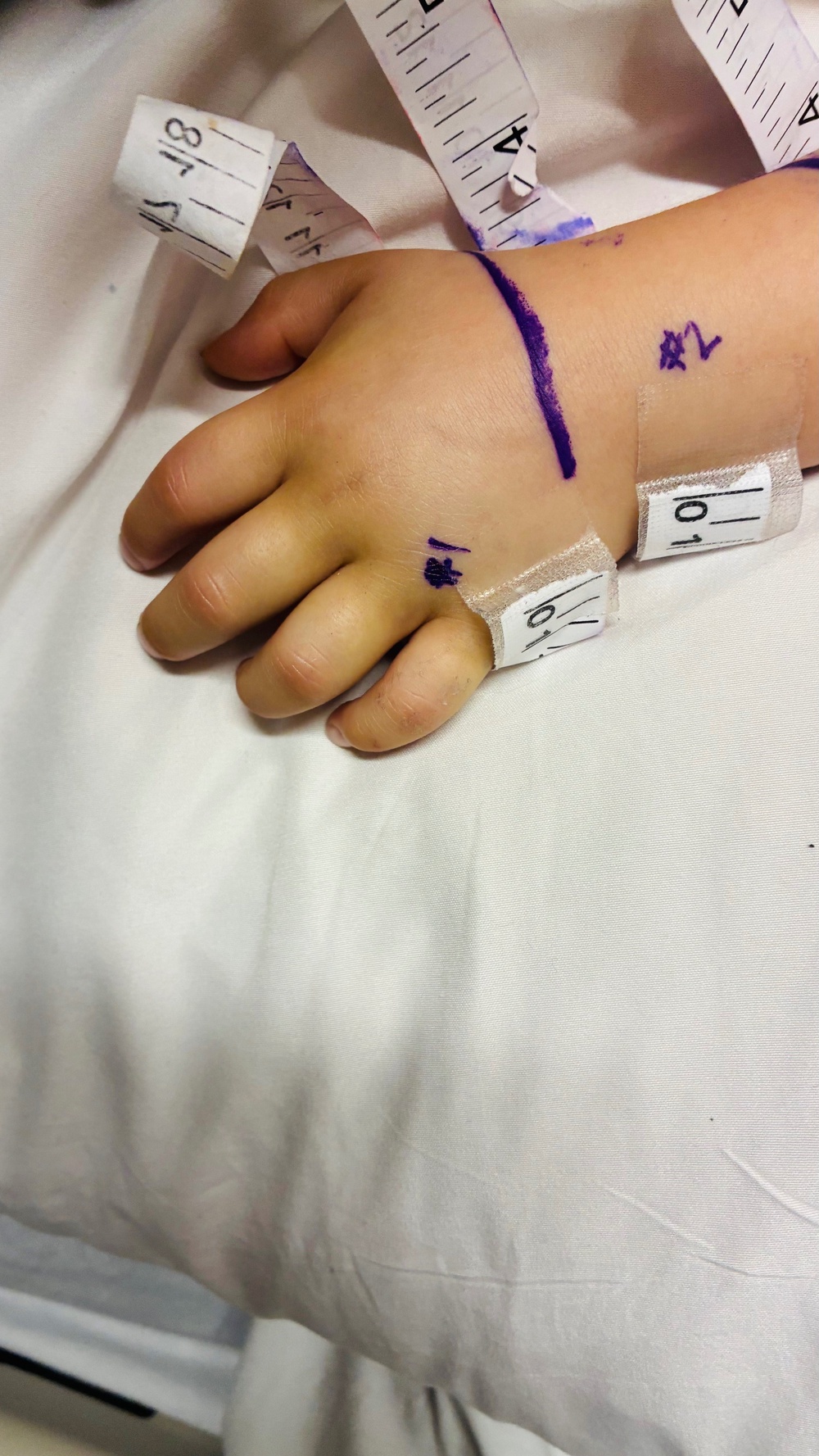 Three-year-old Addy of Santa Clarita, California, had to spend two nights in the ICU and receive three doses of antivenom (Manuel Barajas via GoFundMe)