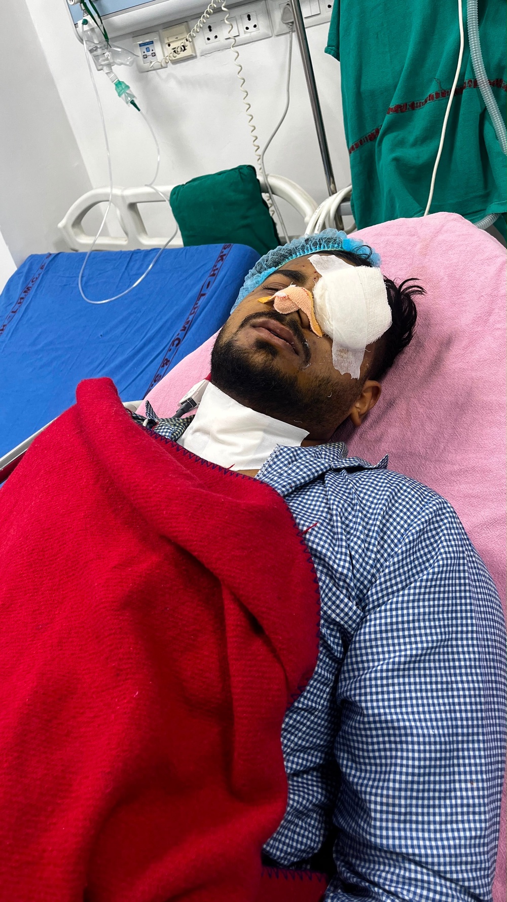Mansoori after pellets were removed from his face (Supplied)