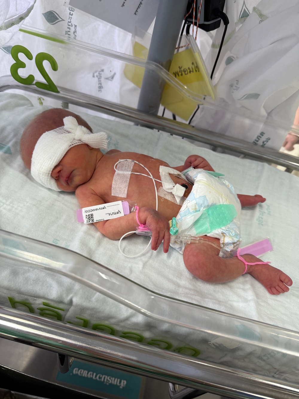 Coco had sepsis when she was born (Collect/PA Real Life)