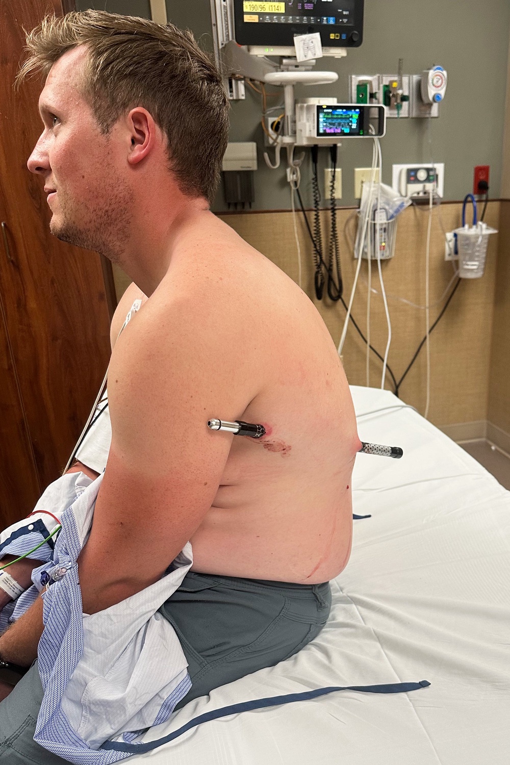 The 44-inch (112-cenimter) steel-tipped pole passed through the flesh beneath Cifaldi’s left arm, missing any vital organs, and protruded from his back (AP)