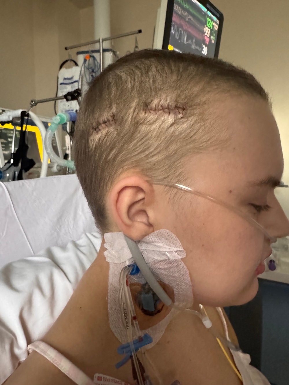 She had burr hole surgery (Collect/PA Real Life)