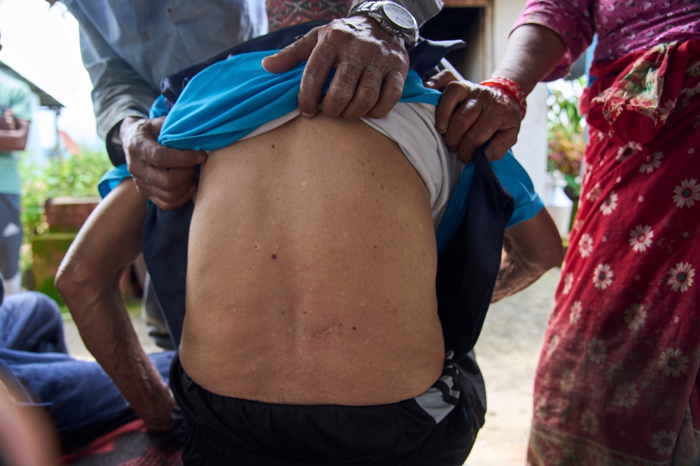 Krishna Bahadur Khadka, 73, shows scars from monkey bites after he was attacked while guarding his crop in Dharamghar, Dolakha district, about 86 kilometers (53 miles) east of Kathmandu, Nepal, Friday, July 24, 2026 (Copyright 2026 The Associated Press. All rights reserved.)