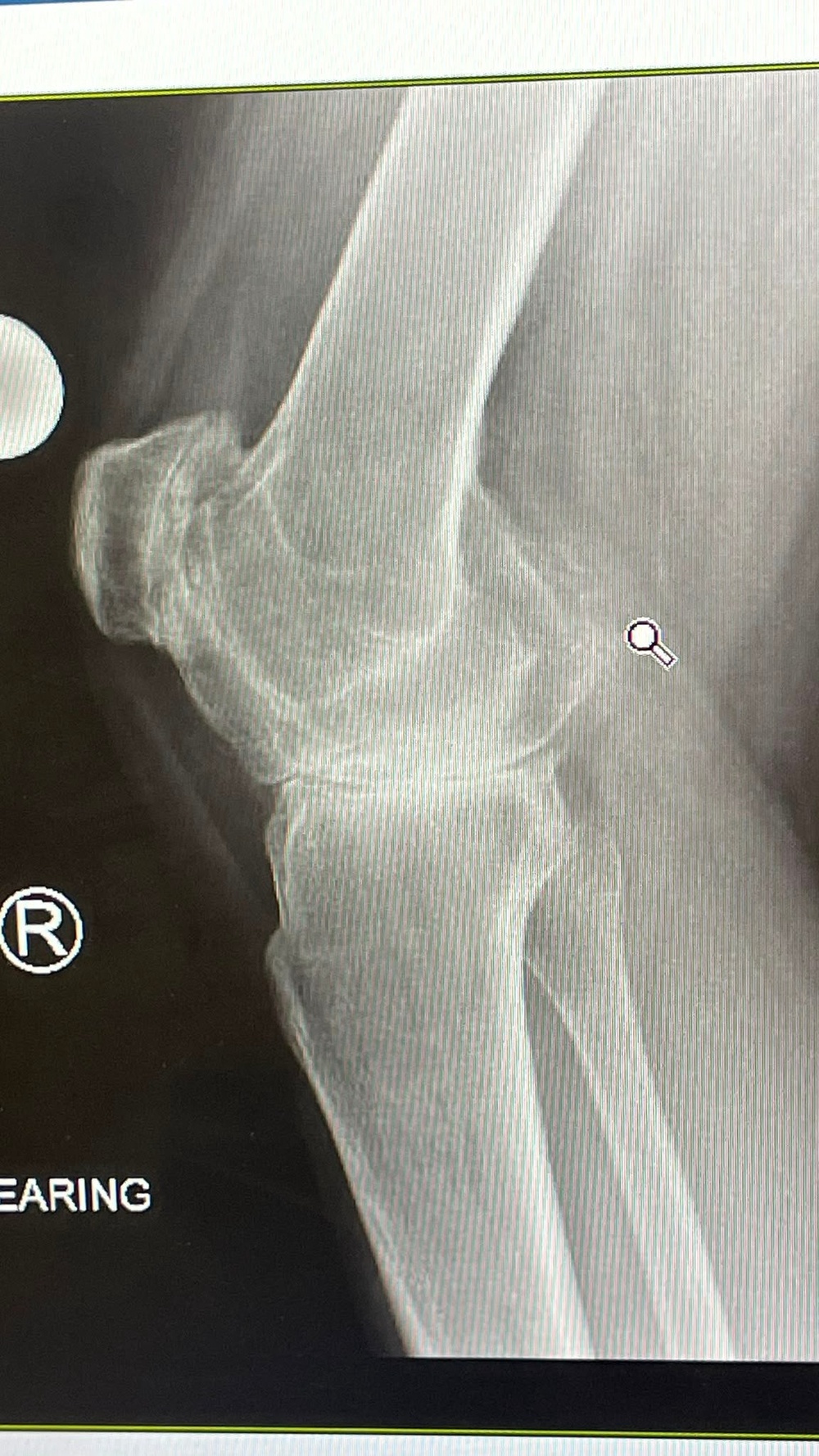 An X-ray of Phoebe’s knee (Collect/PA Real Life)