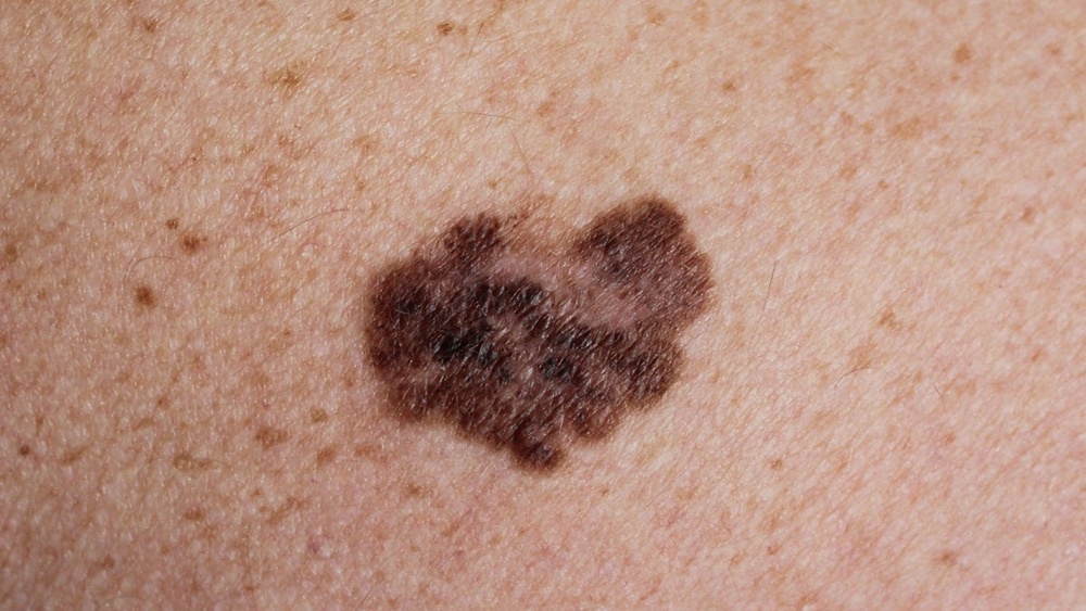 Melanoma is the most deadly form of skin cancer (CDC)