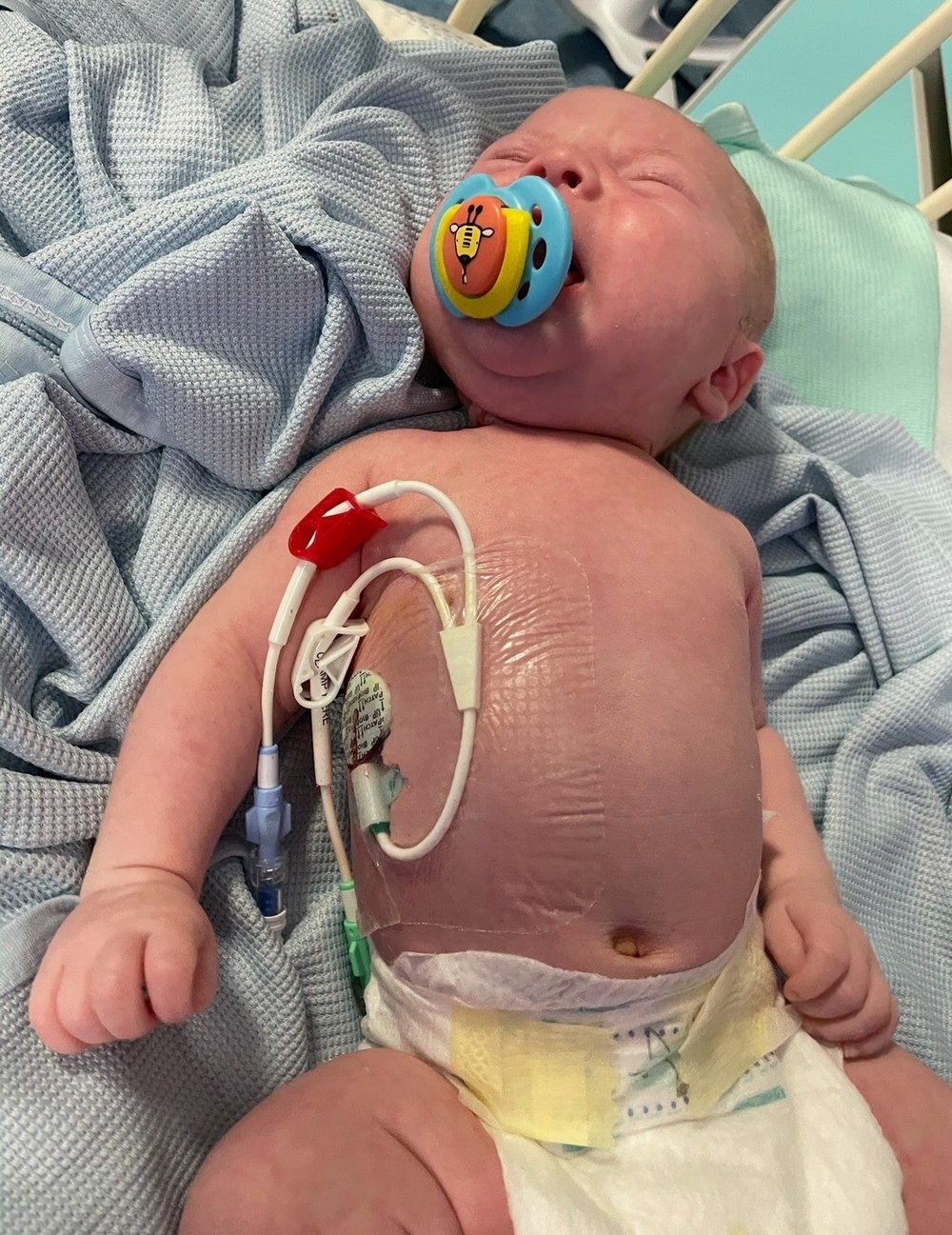 Joey was taken to hospital after he struggled to feed, lost weight and developed persistent jaundice (PA)