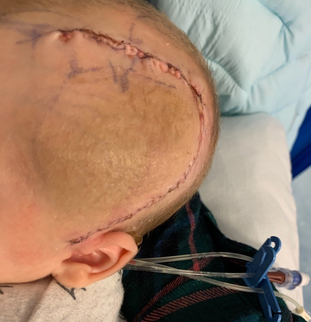 Joey’s surgery scar. (Brain Tumour Research/PA)