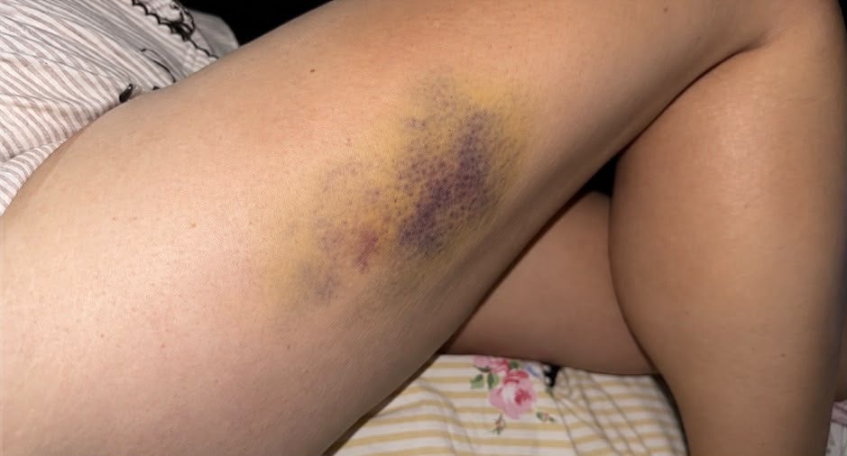 Mrs Bush said she was lucky to not suffer more serious injuries (Hailey Bush)
