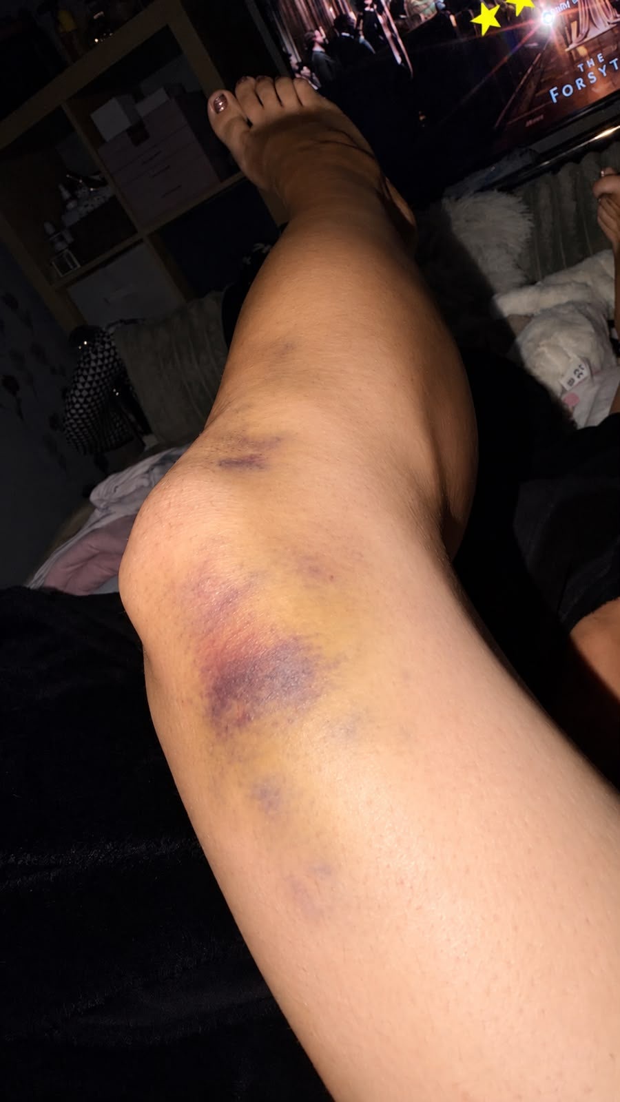 Mrs Bush suffered bruising to her leg following the incident (Hailey Bush)
