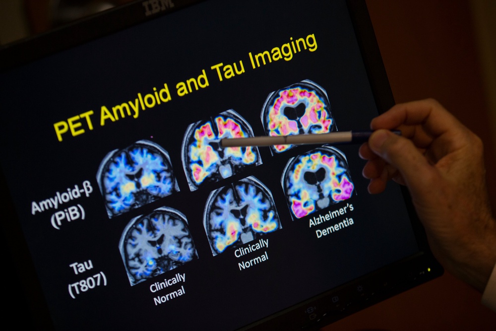 A doctor points to PET scan results that are part of a study on Alzheimer's disease at Georgetown University Hospital, on Tuesday, May 19, 2015, in Washington (Copyright 2024 The Associated Press. All rights reserved.)