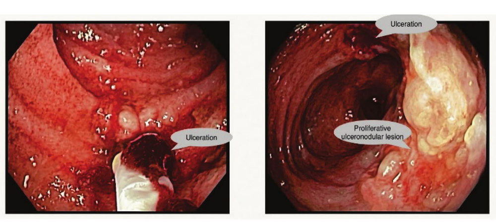 Colonoscopy showing lesions in the patient's terminal ileum (Clinical Case Reports (2026))