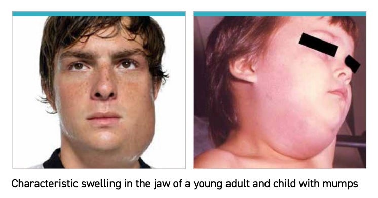Cases of the mumps are characterized by jaw-swelling and puffy cheeks (CDC)