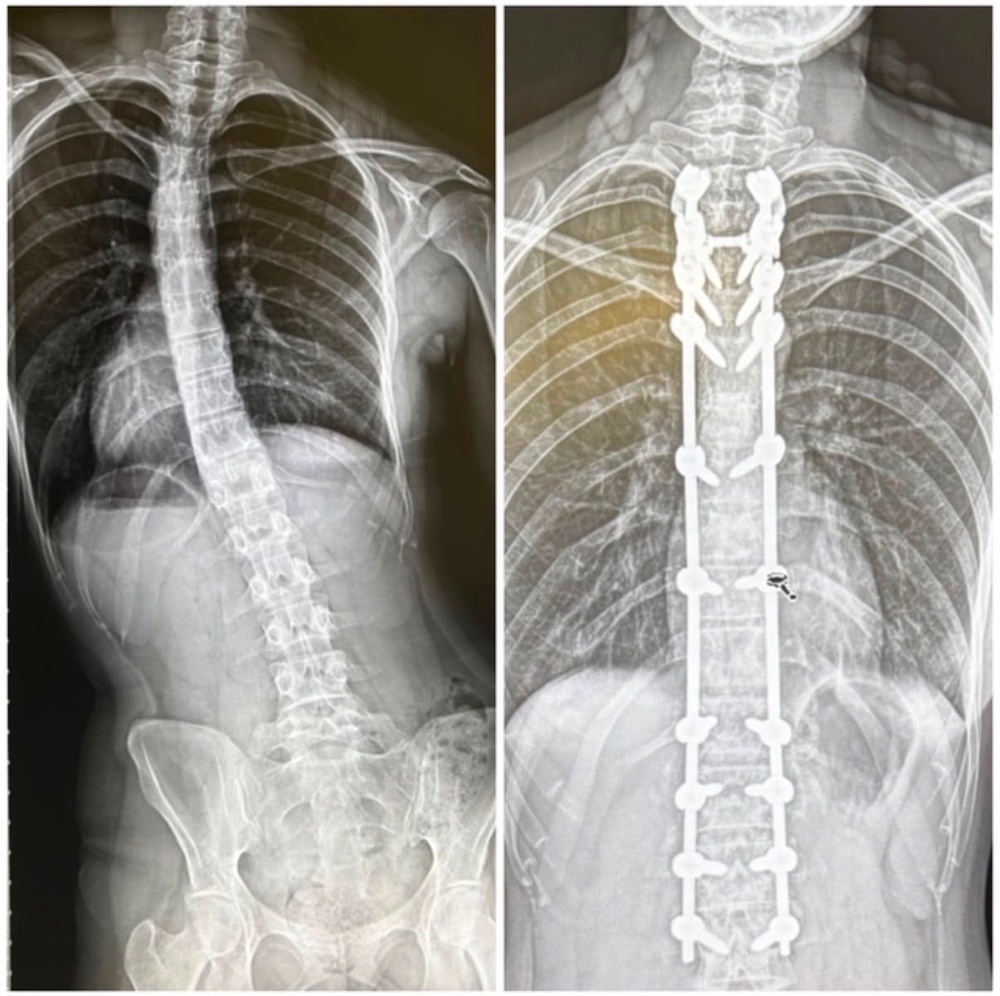 An X-Ray scan showing Jessica's spine before and after surgery (Collect/PA Real Life)