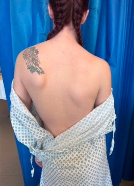 Jessica Ward’s back before her spinal operation (Collect/PA Real Life)