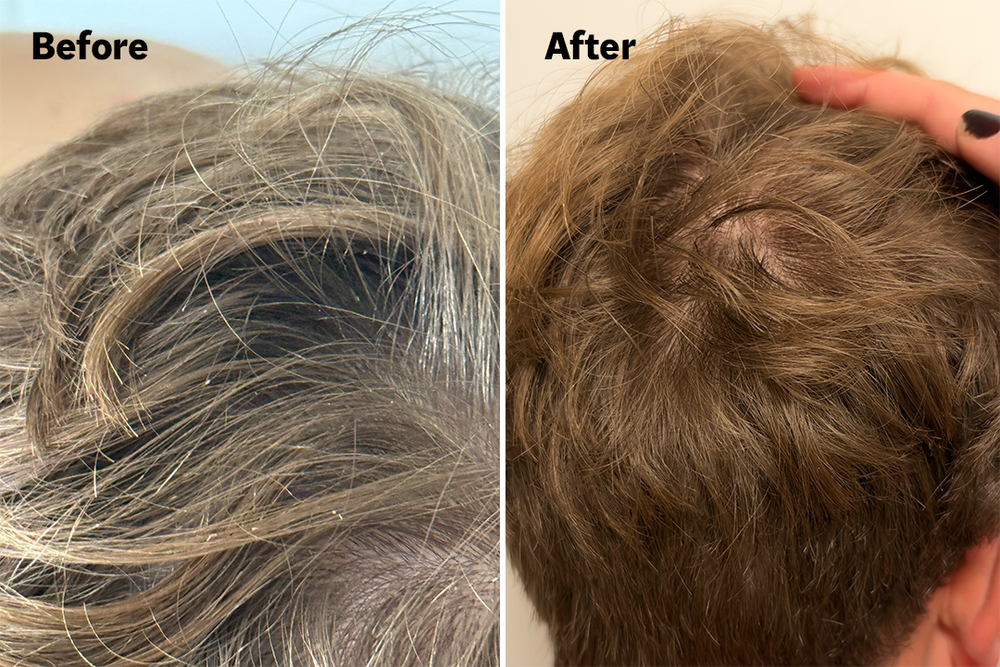 Results after using the scalp soak and the serum (product below) in combination (Lucy Smith/The Independent)