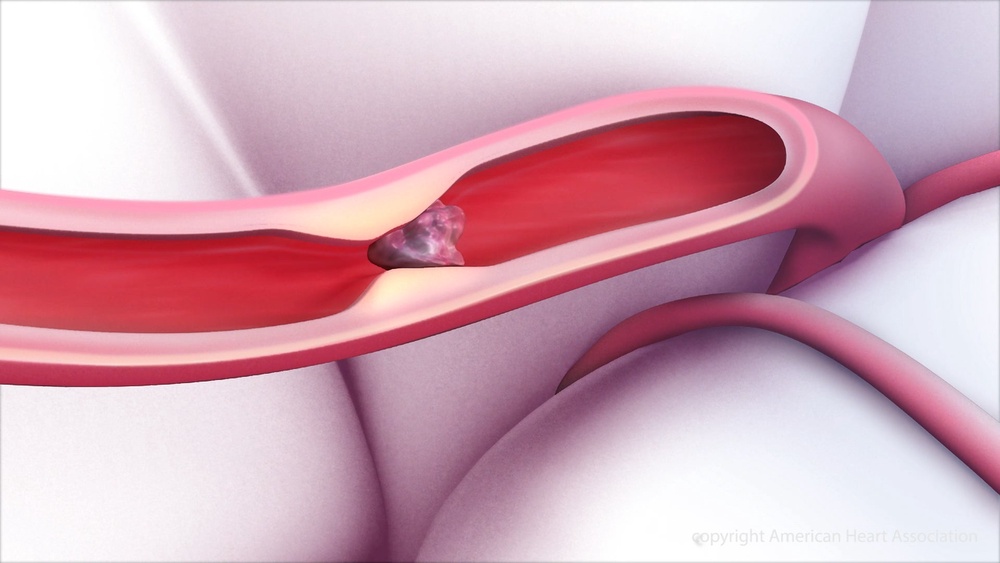 A stroke is typically caused by a clot that disrupts blood flow the the brain, as seen in this illustrative image from the American Heart Association (American Heart Association)