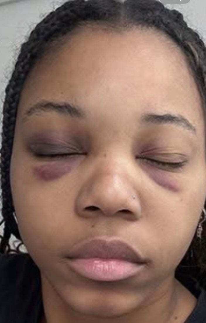 Bonner, who faces misdemeanor charges of disorderly conduct and hindering or interfering with police over the incident, was left with a bruised face, according to a photo shared by her lawyer (Benjamin Taylor)