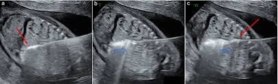 Microwave ablation procedure (Ultrasound in Obstetrics & Gynecology 2026)