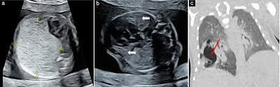 Baby's chest tumour (Ultrasound in Obstetrics & Gynecology 2026)