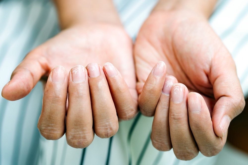 The study found GLP-1 users were four times more likely to experience nail detachment (Getty/iStock)