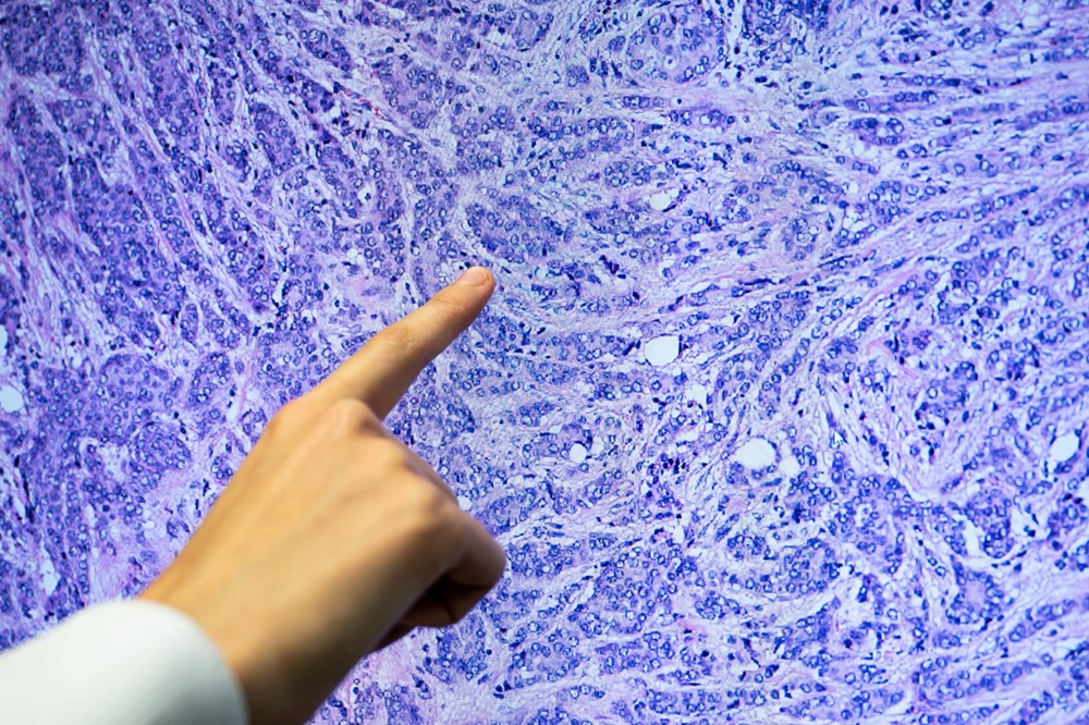A researcher at the National Institute of Health and Medical Research observes a tumour sample (AFP/Getty)
