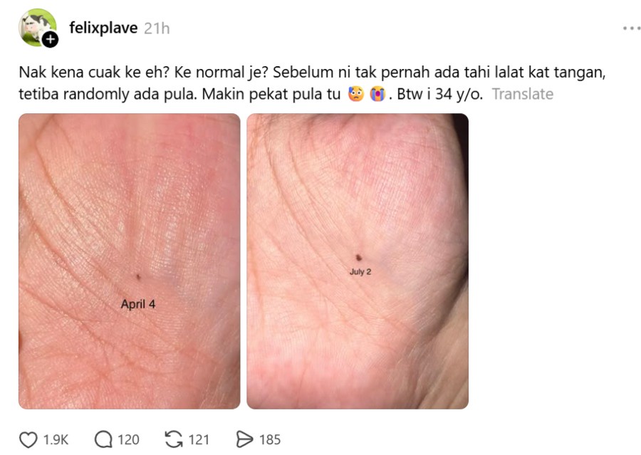 Image from: New Mole on Your Palm? Here’s Why a Viral Post Has Everyone Talking