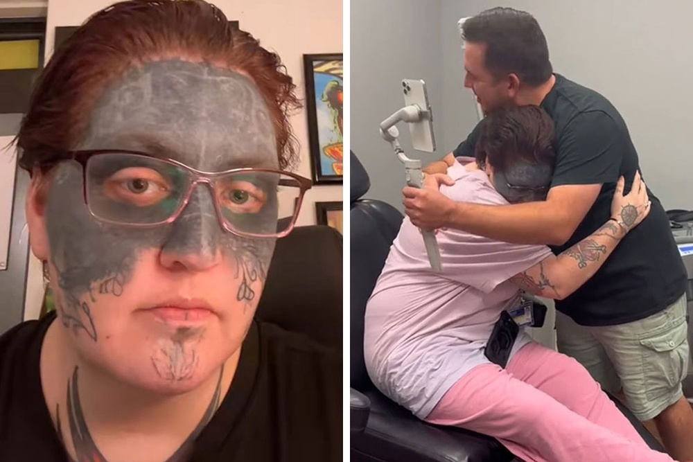 Woman Whose Face Was Tattooed Against Her Will Gets Removal Surgery