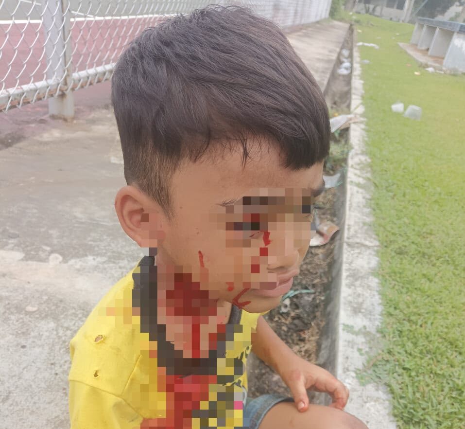 Image from: Lagi kanak-kanak parah digigit anjing liar