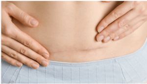 Image from: Peluang ibu kongsi kisah C-section