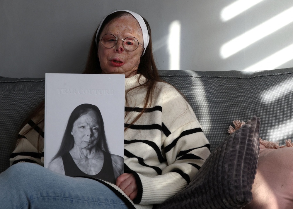 Belgian acid attack survivor fronts fashion book in new awareness campaign
