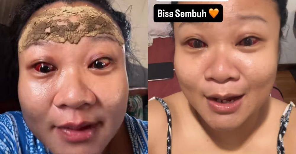 Image from: Pengorbanan ibu! Tular 6.5 juta, mata merah menyala lepas bersalin, wanita ini pecah pembuluh darah gara-gara tersilap meneran