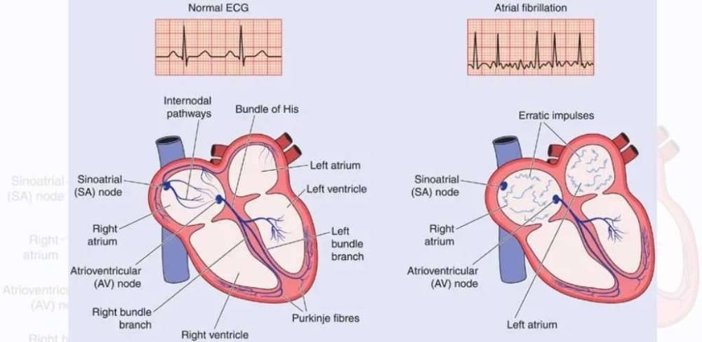 Image from: Kenali aritmia, gangguan rentak jantung yang boleh menyerang tanpa disedari