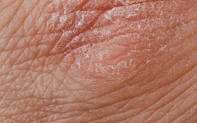 Tips Menjaga Anak Eczema