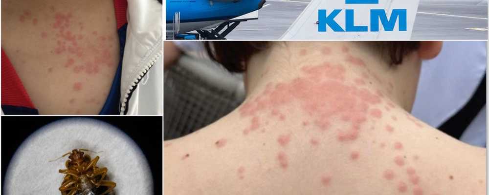 Unrelenting itchy feeling': Family ambushed by bed bugs aboard  transatlantic flight sues over ruined trip