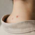 Health Matters: Skin Tags – Harmless Little Growths, or Something to Worry About?