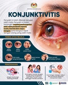 Konjunktivitis : Maksud, Jenis & Langkah Pencegahan