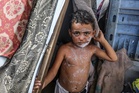 Gaza Dilanda Krisis Kesihatan: Cacar Air Merebak Mendadak Dalam Kalangan Kanak-Kanak Pelarian