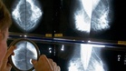 Spain detects 111 cases of rare cancer linked to breast implants