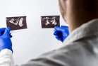Why some men with prostate cancer may soon need only five radiotherapy sessions