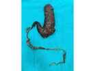 Doctors remove giant hairball from 30-year-old woman suffering months of stomach Pain
