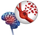 DoctorSpeak: How untreated high BP damages brain