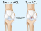 DoctorSpeak : All about knee injuries