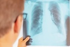 ICMR invites varsities to fast-track TB elimination through enhanced diagnostics and drug development