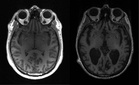 Blood, biopsy and voice may detect Alzheimer’s early