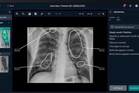AI-assisted x-ray may lower TB detection costs in rural areas