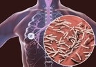 Kes tibi meningkat 4.4 peratus, diagnosis lewat antara cabaran utama